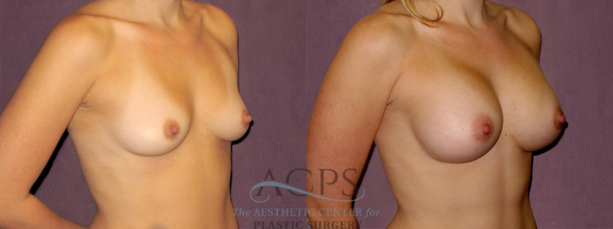 Before & After Breast Augmentation Case 960 Oblique Right View: View in Houston, TX