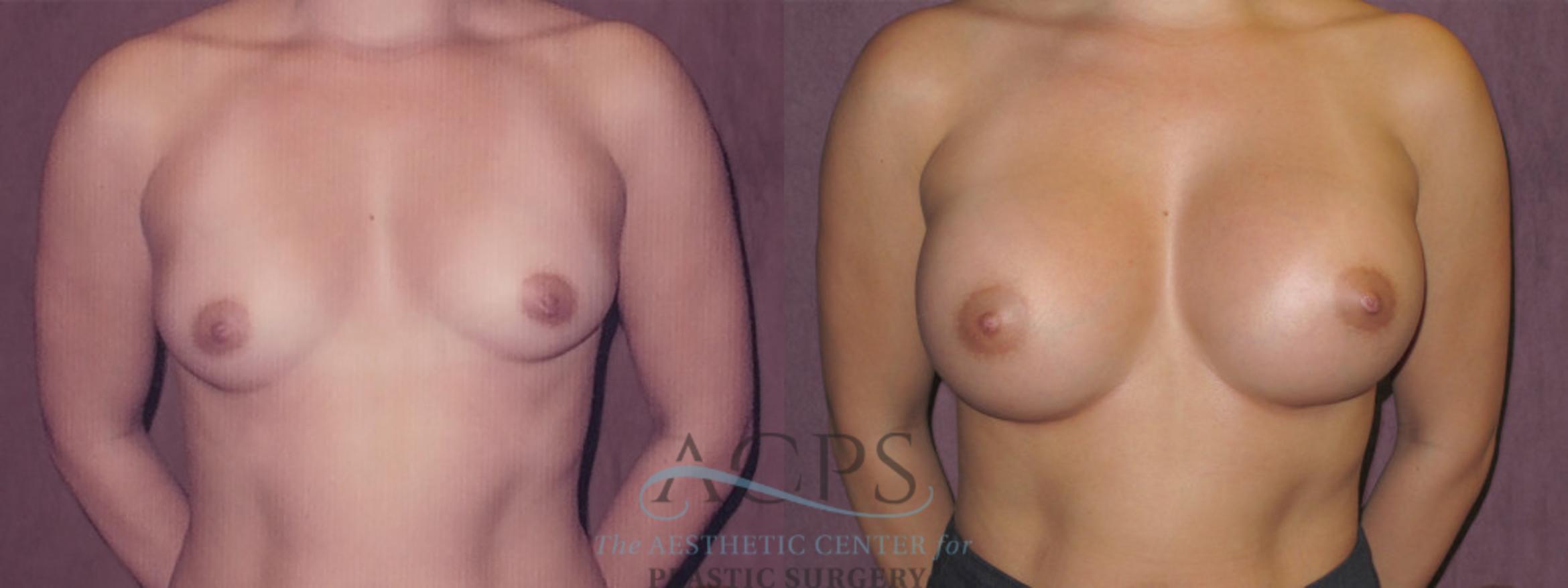 Before & After Breast Augmentation Case 961 Front View: View in Houston, TX