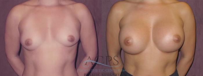 Before & After Breast Augmentation Case 961 Front View: View in Houston, TX