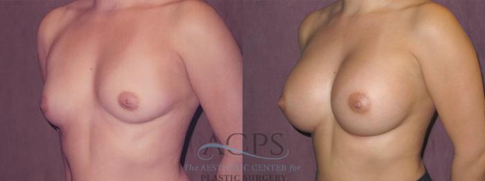 Before & After Breast Augmentation Case 961 Oblique Left View: View in Houston, TX