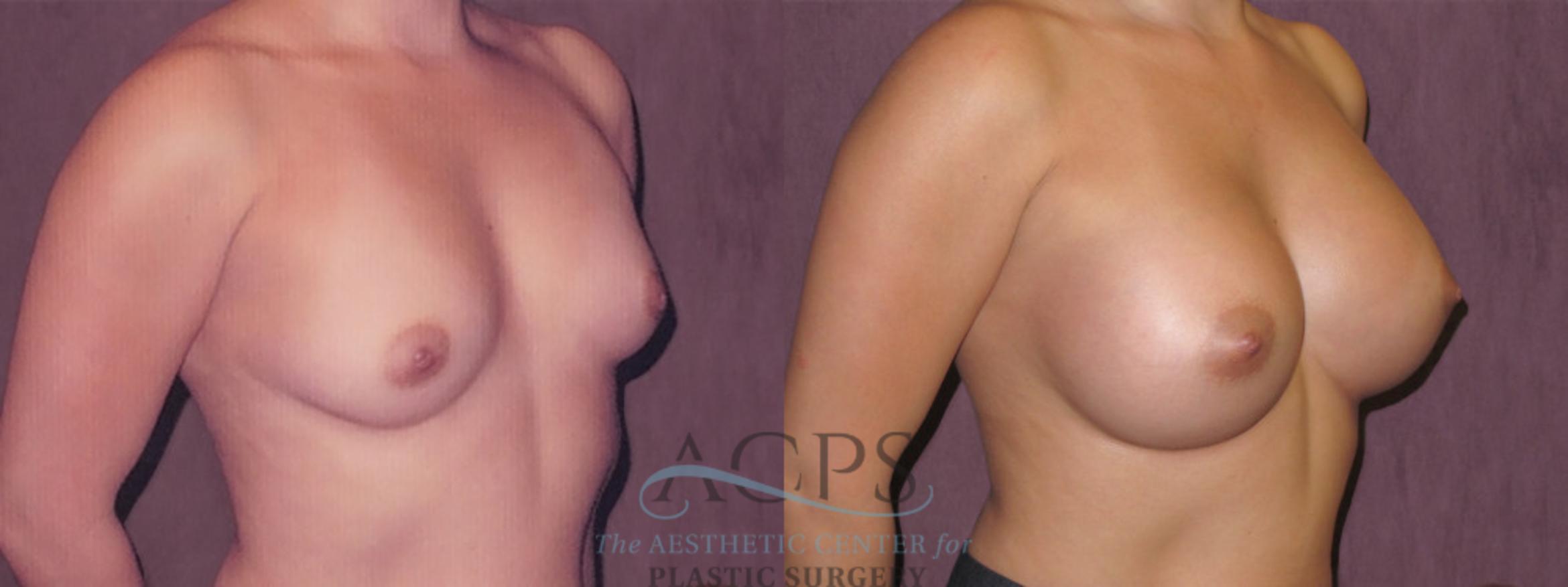 Before & After Breast Augmentation Case 961 Oblique Right View: View in Houston, TX