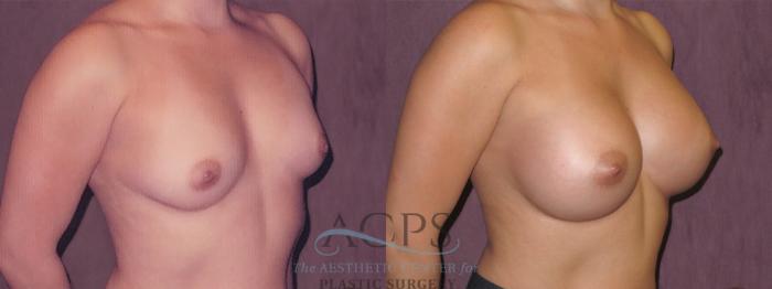 Before & After Breast Augmentation Case 961 Oblique Right View: View in Houston, TX