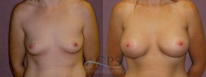 Before & After Breast Augmentation Case 962 Front View: View in Houston, TX