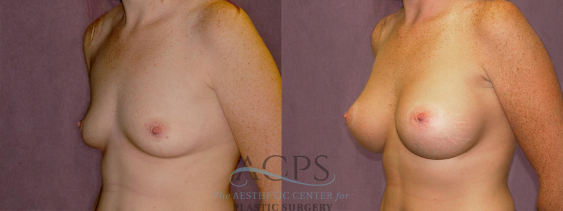 Before & After Breast Augmentation Case 962 Oblique Left View: View in Houston, TX