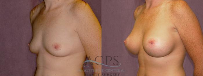 Before & After Breast Augmentation Case 962 Oblique Left View: View in Houston, TX