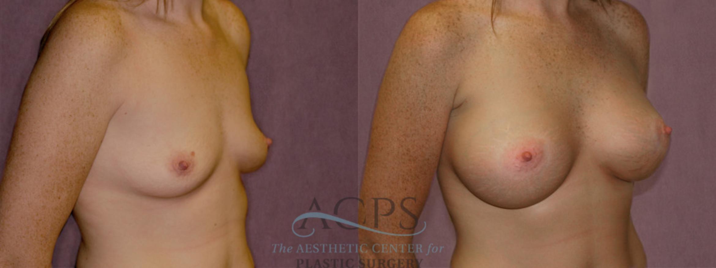 Before & After Breast Augmentation Case 962 Oblique Right View: View in Houston, TX
