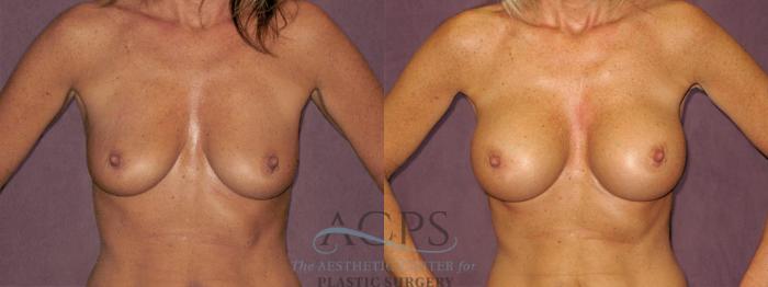 Before & After Breast Augmentation Case 963 Front View: View in Houston, TX