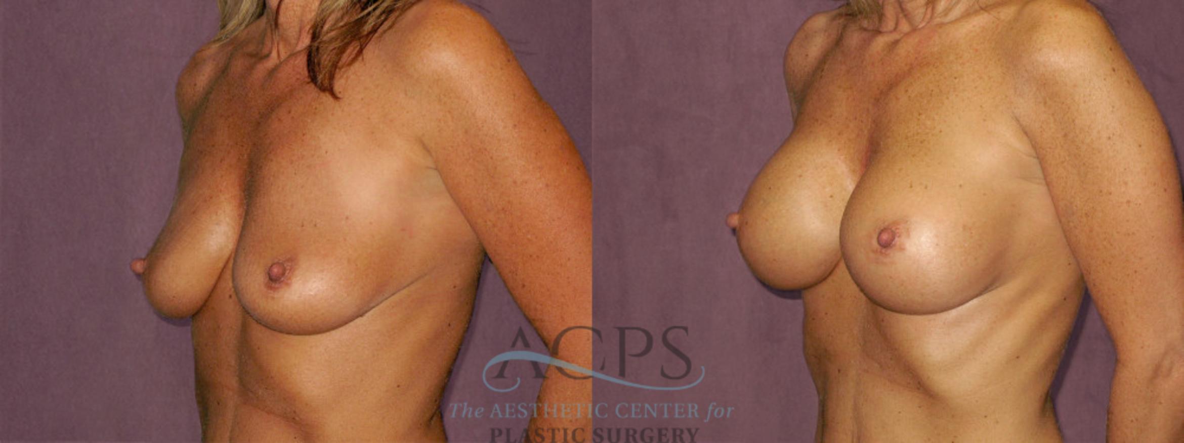 Before & After Breast Augmentation Case 963 Oblique Left View: View in Houston, TX