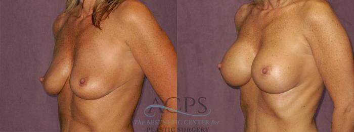 Before & After Breast Augmentation Case 963 Oblique Left View: View in Houston, TX