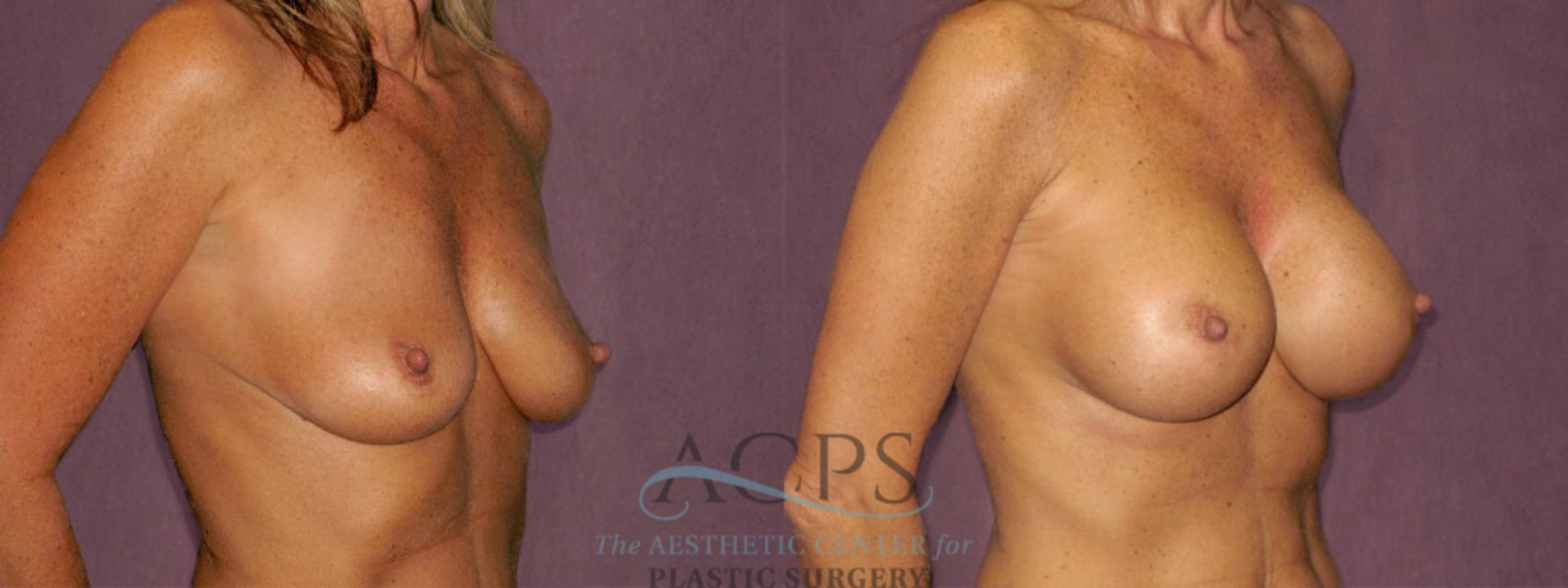 Before & After Breast Augmentation Case 963 Oblique Right View: View in Houston, TX