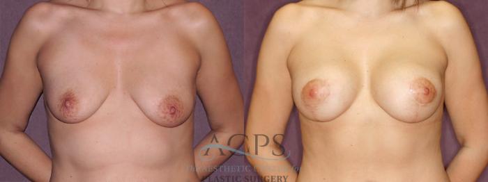 Before & After Breast Lift Case 964 Front View: View in Houston, TX