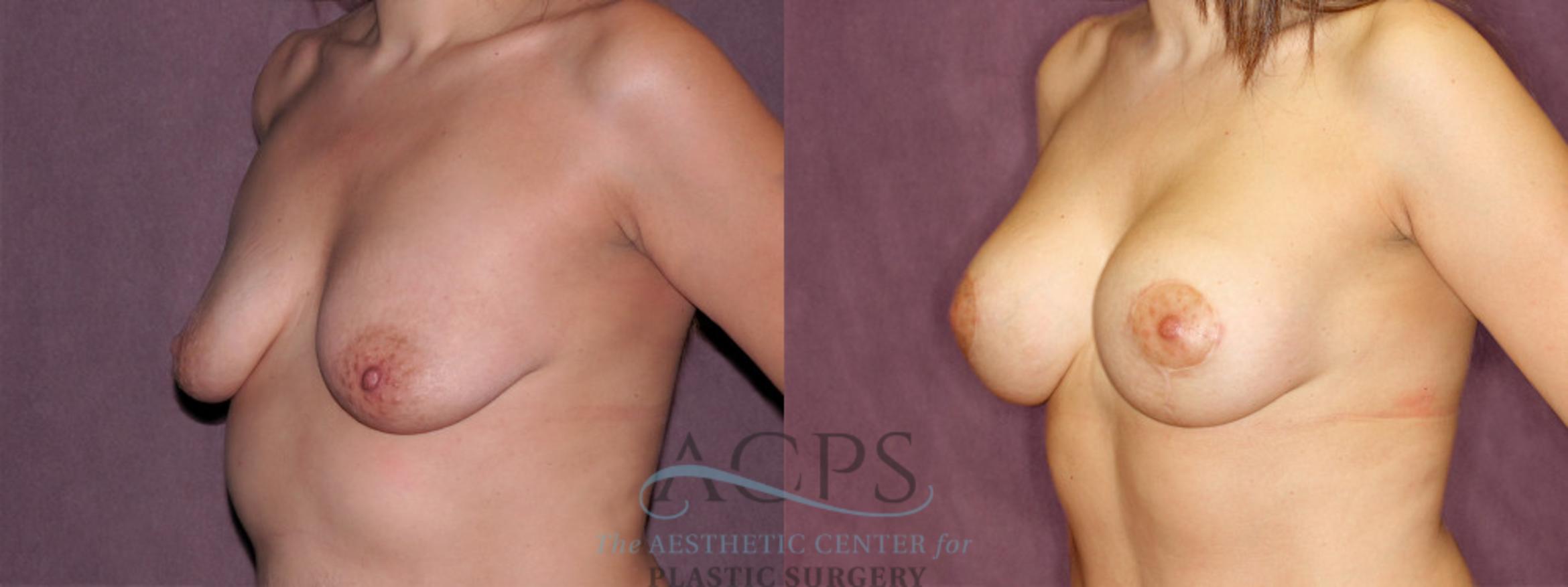 Before & After Breast Lift Case 964 Oblique Left View: View in Houston, TX