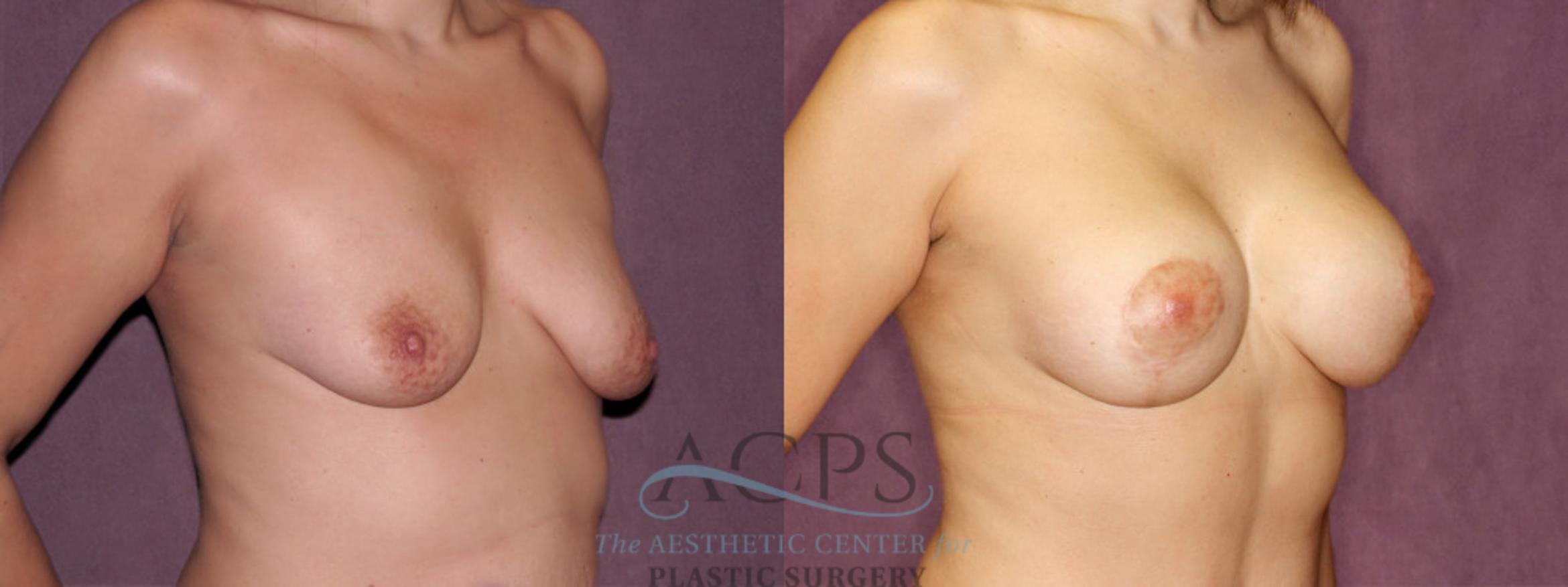 Before & After Breast Lift Case 964 Oblique Right View: View in Houston, TX