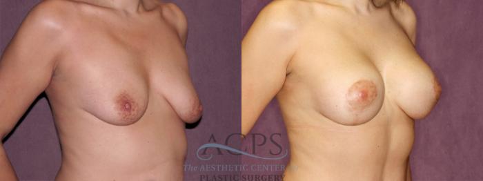 Before & After Breast Lift Case 964 Oblique Right View: View in Houston, TX