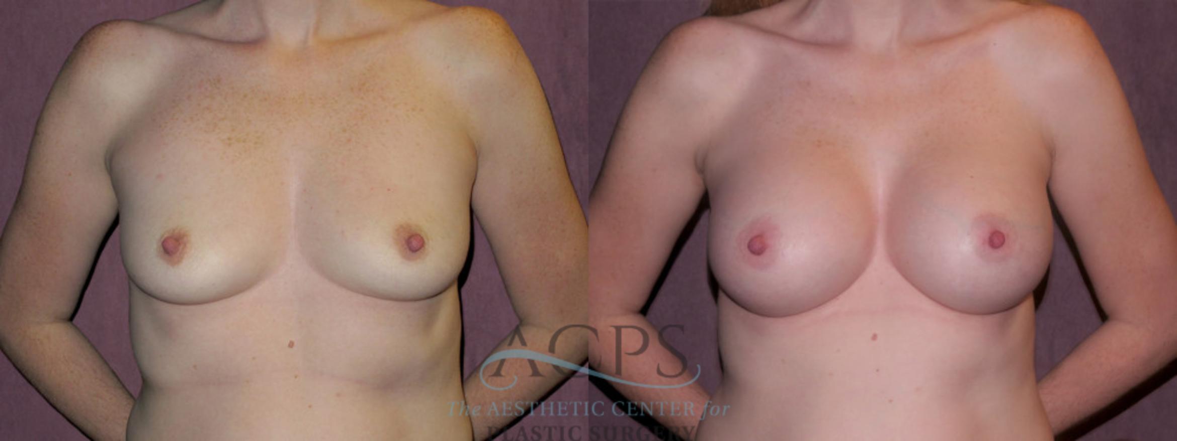 Before & After Breast Augmentation Case 965 Front View: View in Houston, TX