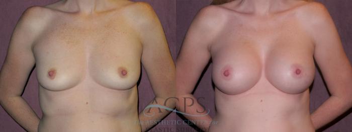 Before & After Breast Augmentation Case 965 Front View: View in Houston, TX