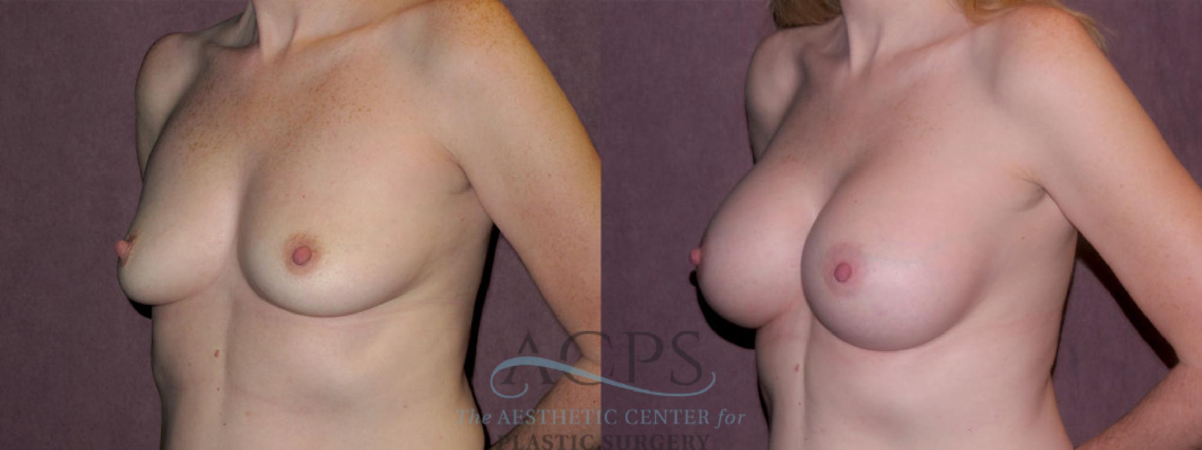 Before & After Breast Augmentation Case 965 Oblique Left View: View in Houston, TX