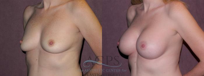 Before & After Breast Augmentation Case 965 Oblique Left View: View in Houston, TX