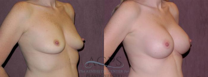 Before & After Breast Augmentation Case 965 Oblique Right View: View in Houston, TX