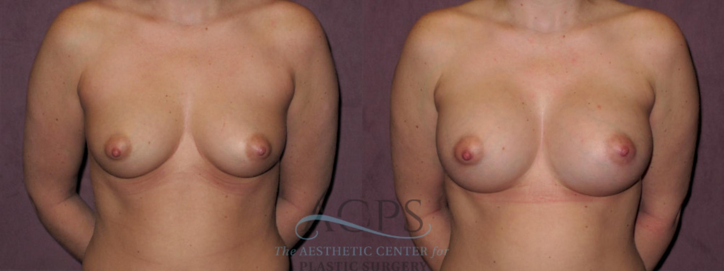 Before & After Breast Augmentation Case 966 Front View: View in Houston, TX