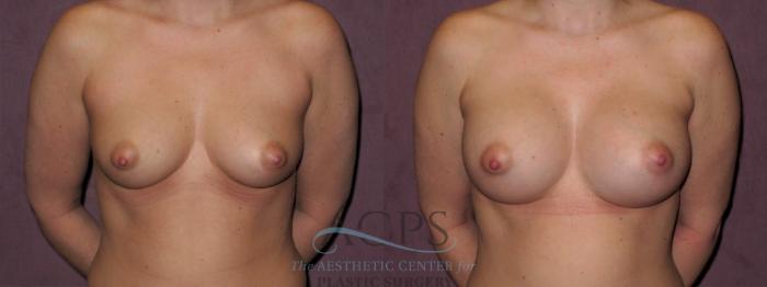 Before & After Breast Augmentation Case 966 Front View: View in Houston, TX