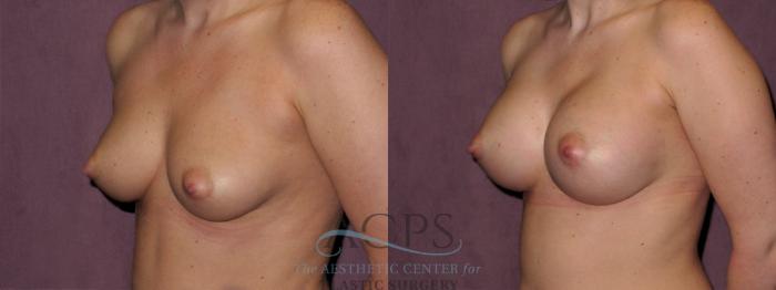 Before & After Breast Augmentation Case 966 Oblique Left View: View in Houston, TX