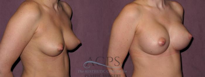 Before & After Breast Augmentation Case 966 Oblique Right View: View in Houston, TX