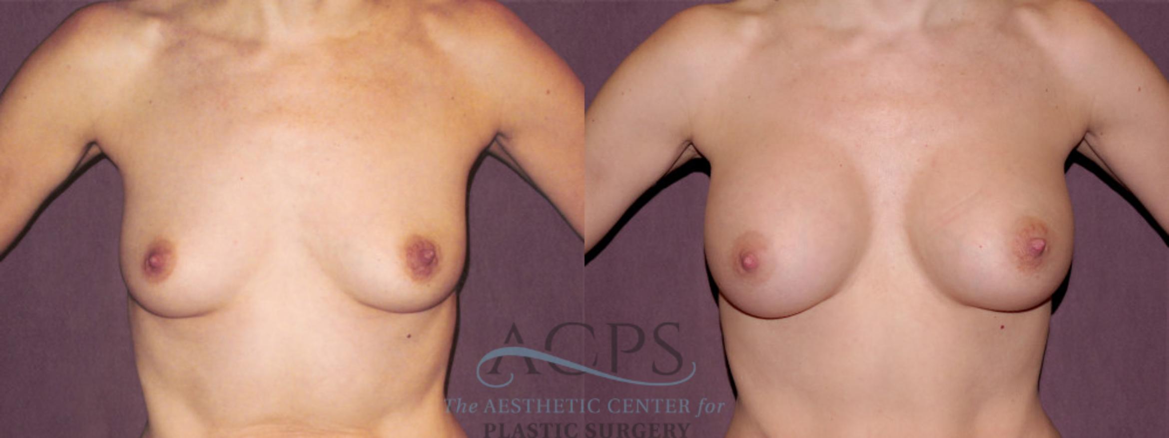 Before & After Breast Augmentation Case 967 Front View: View in Houston, TX