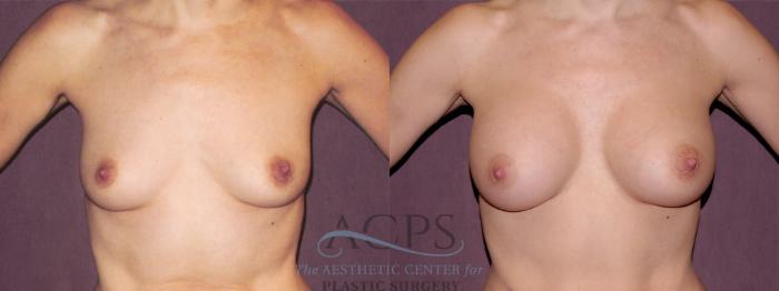 Before & After Breast Augmentation Case 967 Front View: View in Houston, TX