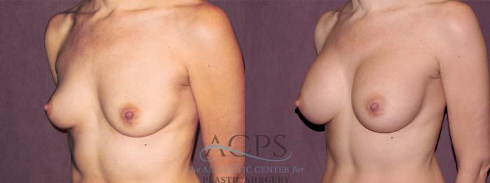 Before & After Breast Augmentation Case 967 Oblique Left View: View in Houston, TX