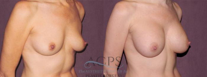 Before & After Breast Augmentation Case 967 Oblique Right View: View in Houston, TX