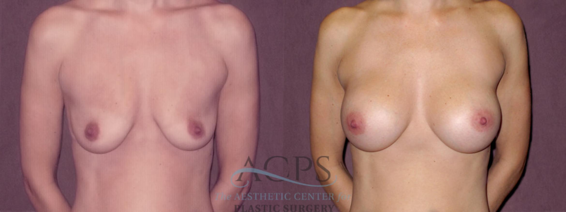 Before & After Breast Augmentation Case 968 Front View: View in Houston, TX