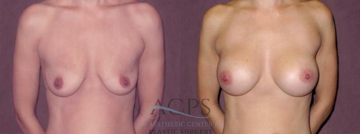 Before & After Breast Augmentation Case 968 Front View: View in Houston, TX