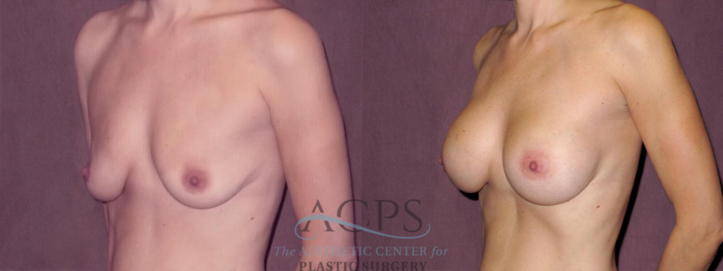 Before & After Breast Augmentation Case 968 Oblique Left View: View in Houston, TX