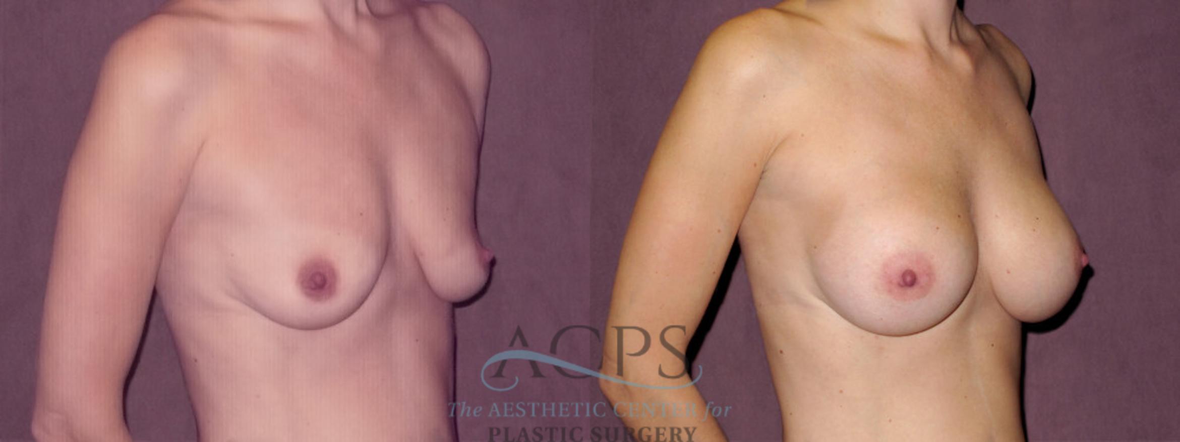 Before & After Breast Augmentation Case 968 Oblique Right View: View in Houston, TX