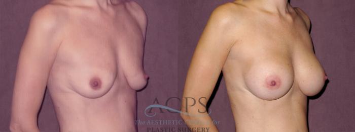 Before & After Breast Augmentation Case 968 Oblique Right View: View in Houston, TX