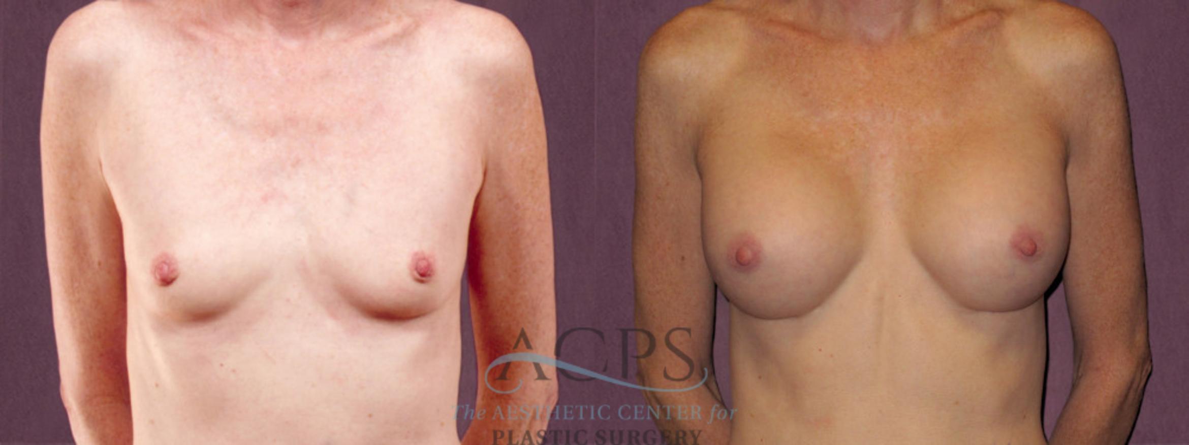 Before & After Breast Augmentation Case 969 Front View: View in Houston, TX