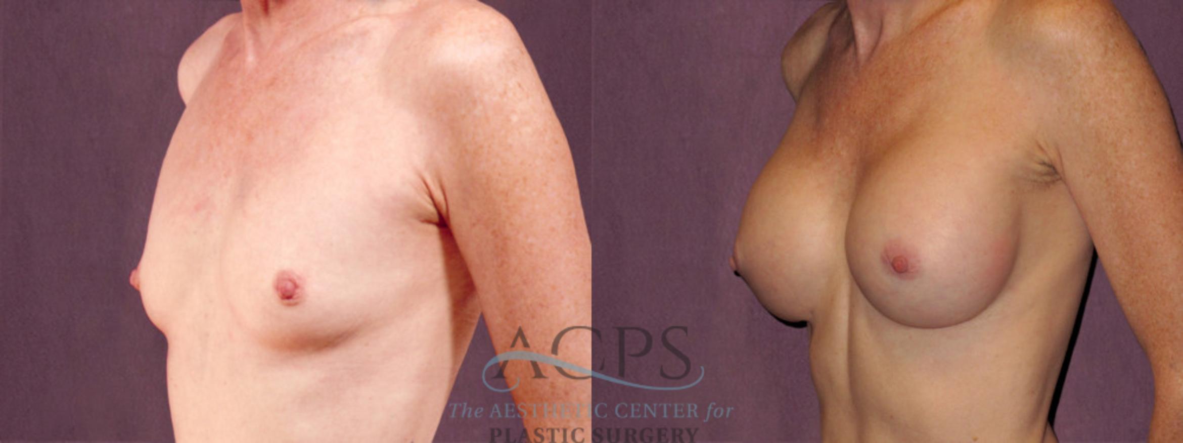 Before & After Breast Augmentation Case 969 Oblique Left View: View in Houston, TX
