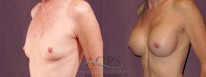 Before & After Breast Augmentation Case 969 Oblique Left View: View in Houston, TX