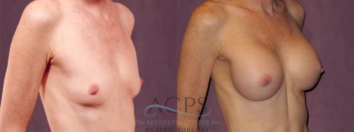 Before & After Breast Augmentation Case 969 Oblique Right View: View in Houston, TX