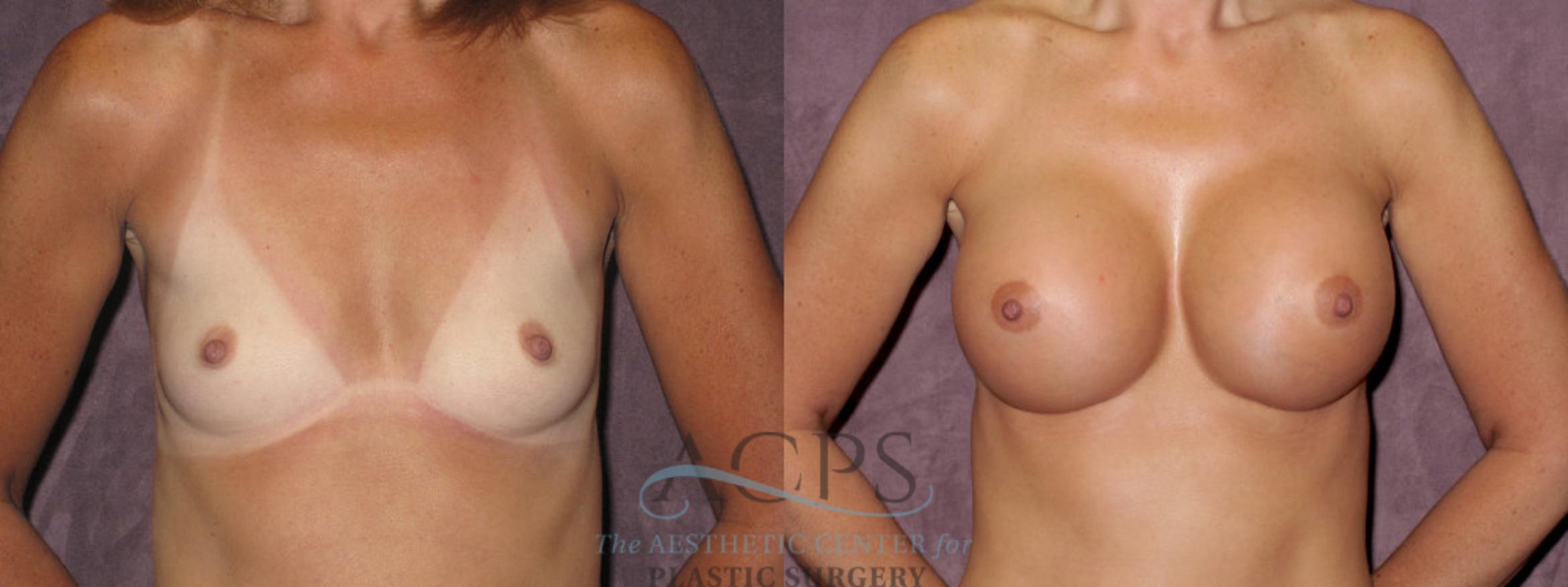Before & After Breast Augmentation Case 970 Front View: View in Houston, TX