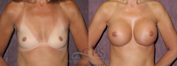 Before & After Breast Augmentation Case 970 Front View: View in Houston, TX