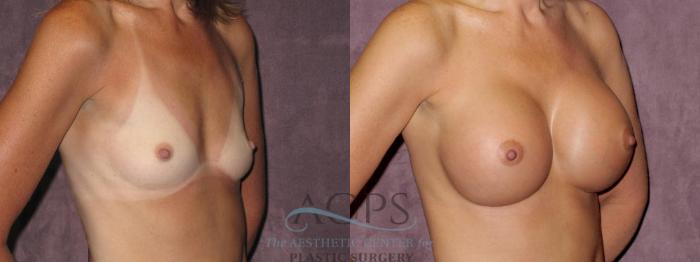 Before & After Breast Augmentation Case 970 Oblique Right View: View in Houston, TX