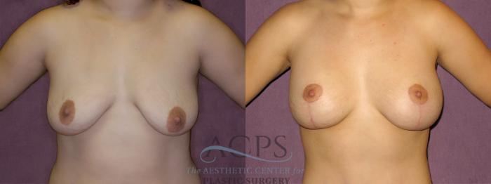 Before & After Breast Lift Case 971 Front View: View in Houston, TX
