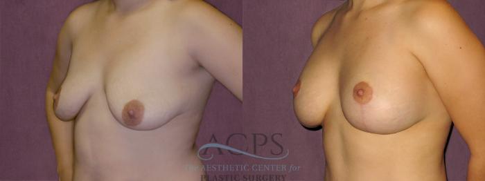 Before & After Breast Lift Case 971 Oblique Left View: View in Houston, TX