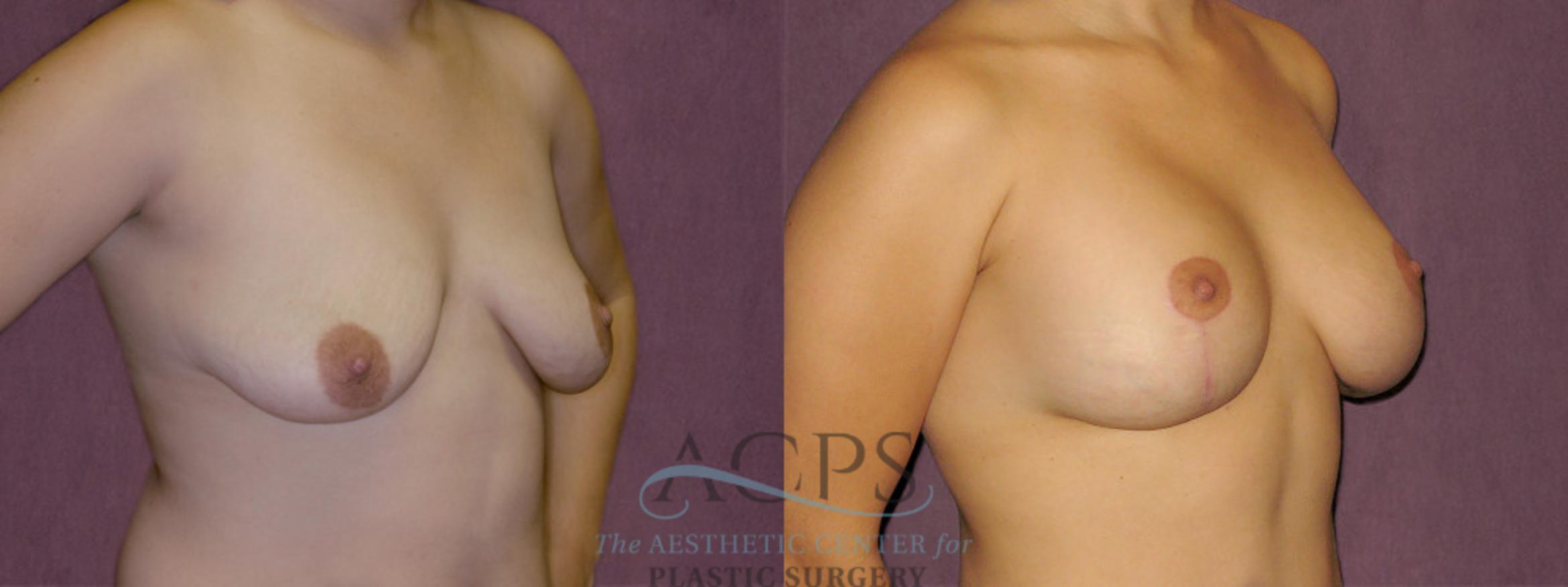 Before & After Breast Lift Case 971 Oblique Right View: View in Houston, TX