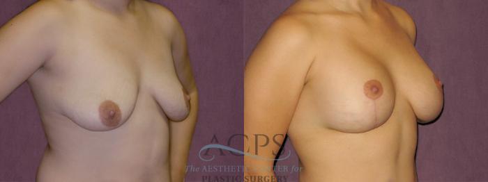 Before & After Breast Lift Case 971 Oblique Right View: View in Houston, TX