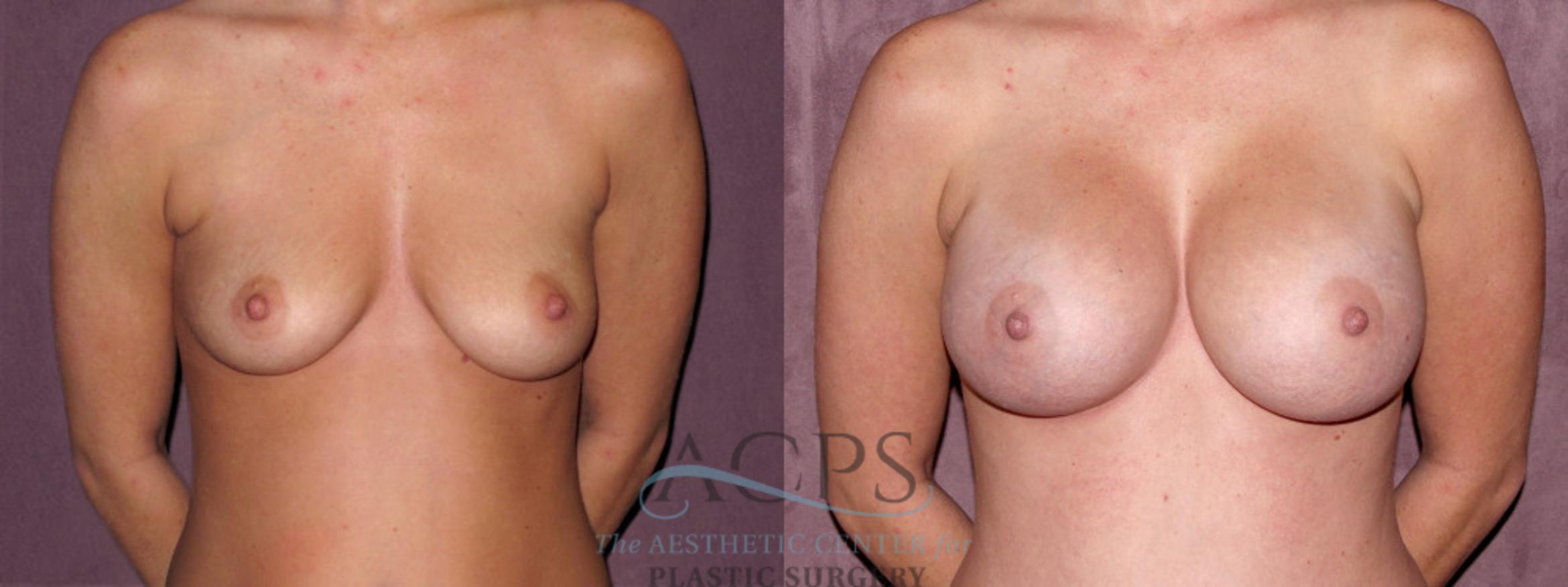 Before & After Breast Augmentation Case 972 Front View: View in Houston, TX