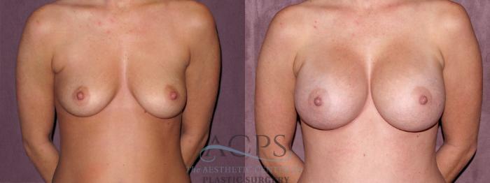 Before & After Breast Augmentation Case 972 Front View: View in Houston, TX