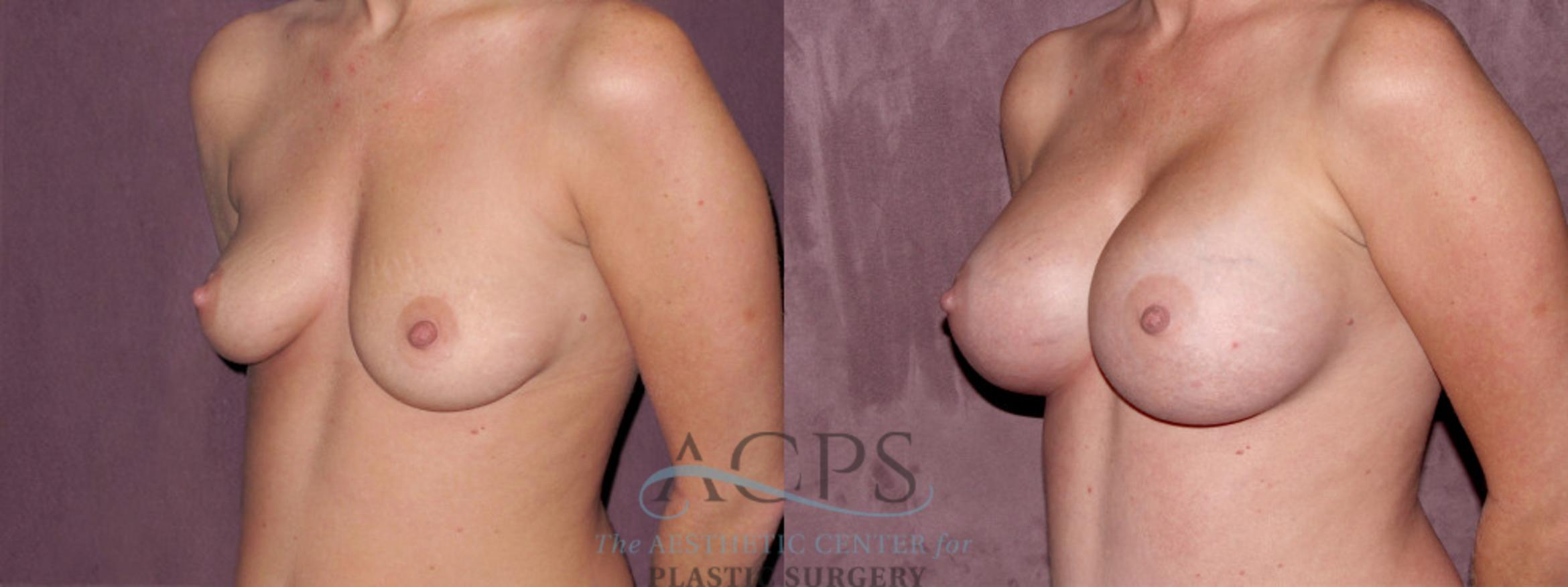 Before & After Breast Augmentation Case 972 Oblique Left View: View in Houston, TX